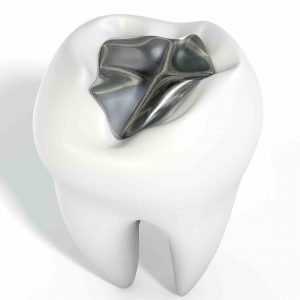 Amalgam waste